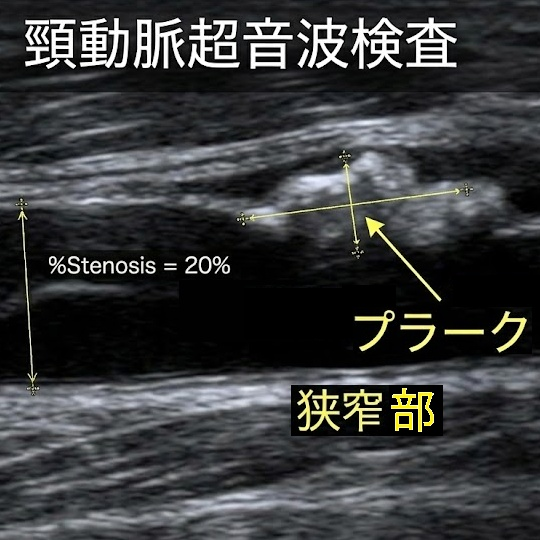 頸動脈エコーイメージ
